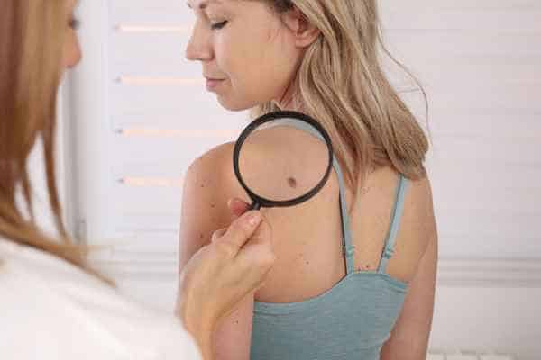 What Are Traditional Skin Lesion Removal Methods Uppingham?