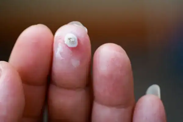 Image of white wart before cryopen treatment Uppingham