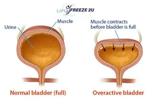 diagram of overactive bladder treatment Uppingham