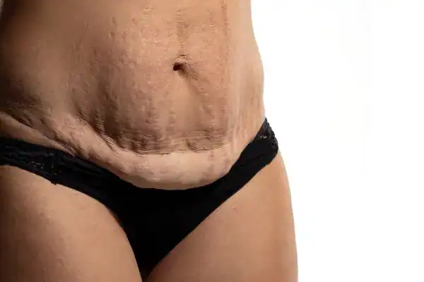 loose skin after weight loss injections Uppingham