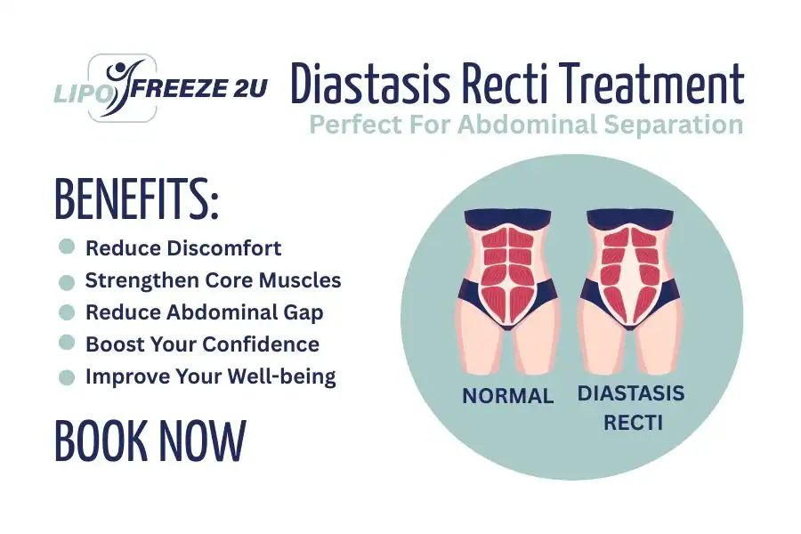 Benefits of body toning treatment Uppingham for Diastasis recti