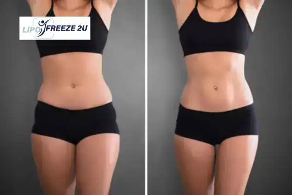 How Can LIPO FREEZE 2U Support Your Post-Pregnancy Body Recovery Uppingham?