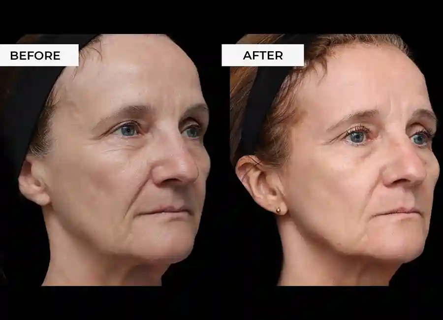 How Many RF Microneedling Sessions Will You Need to See a Difference Uppingham?