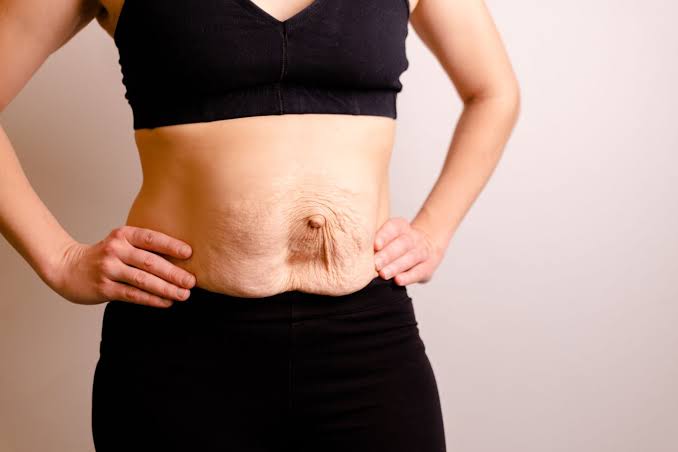 Is Surgery Really the Only Way to Repair Diastasis Recti Uppingham?